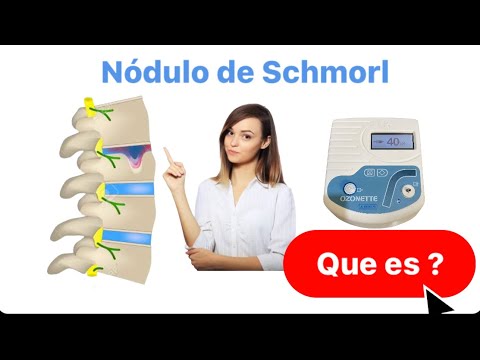 Ultrasuoni e radiografie dellarticolazione della spalla Il dolore e il suo lato destro e inferiore della schiena