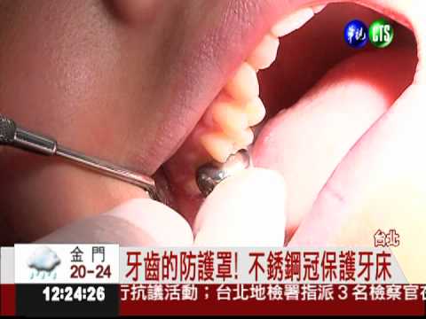 不銹鋼冠護乳牙 標準價1顆1千