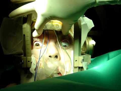 Functional Neurosurgery- psychosurgery-video-Dr Garcia de Sola