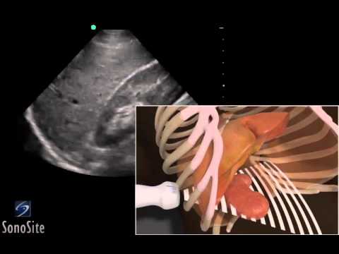 How To: EFAST - RUQ (Right Upper Quadrant) 3D Video