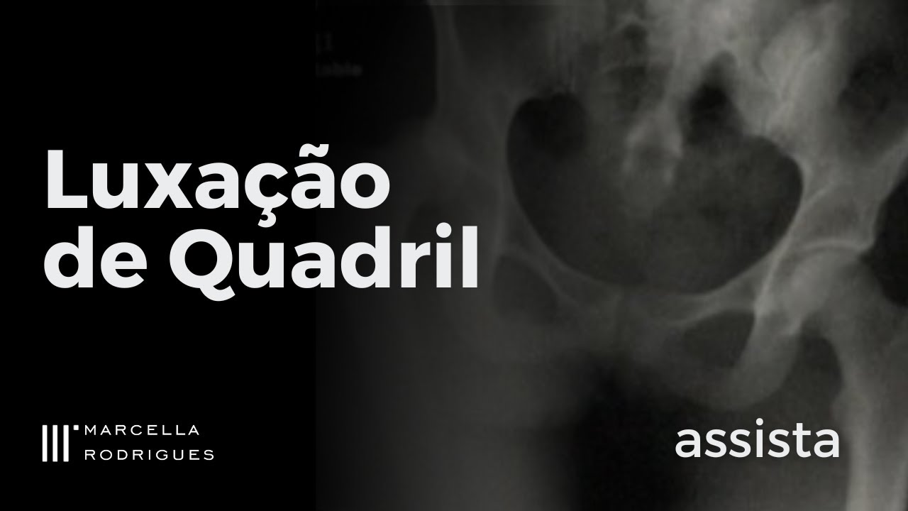 Luxação de Quadril