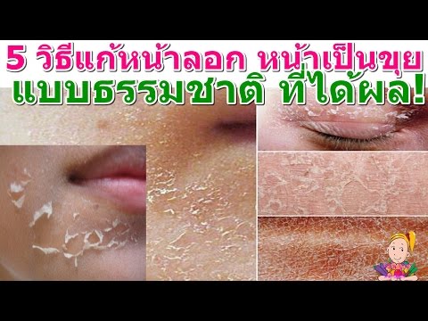 โรคสะเก็ดเงินไพริดอกซิ การรักษา cyclosporin ของโรคสะเก็ดเงิน