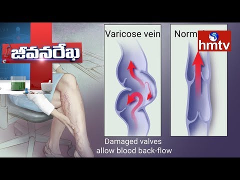tratamentul operaional al costului varicozei varicoase)