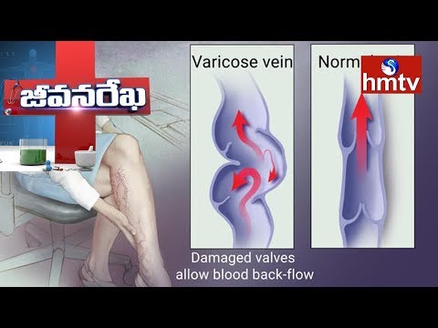 varicose pelvis într-un barbat