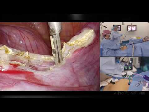 Laparoscopic Hysterectomy