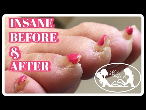 Ointment od halamang-singaw sa chlenіv Toe halamang-singaw ay nakakahawa
