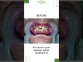 Best treatment for gingivitis #gumdisease #shorts (2022)