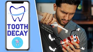 What is Tooth Decay - My Dental Care App with Dr. Divani
