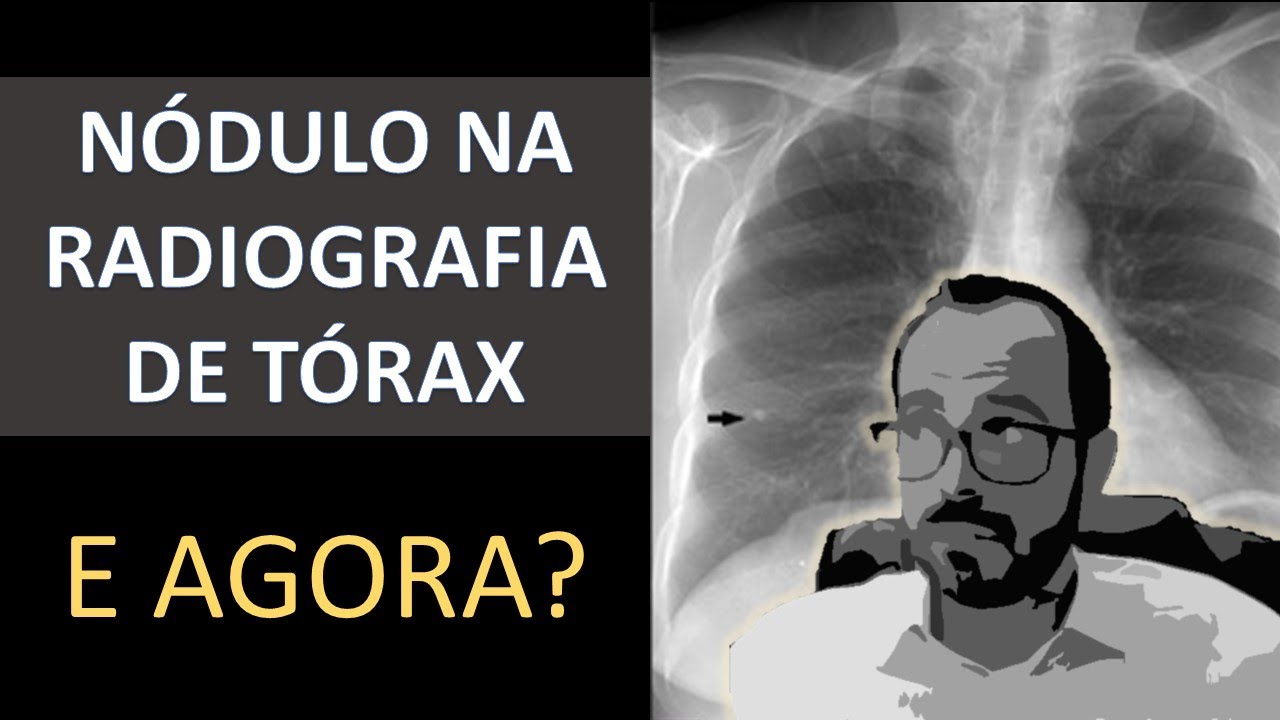 Nódulo pulmonar na Radiografia de Tórax? O que fazer?