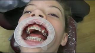 Watch how we put your braces on!