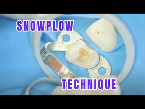 Snowplow Technique 🦷