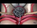 Surgical Treatment Options For Brain Aneurysms Ethan Winkler MD PhD