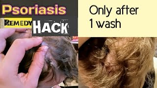 PSORIASIS: THE HOME REMEDY (Get Rid of the Bumpy Patches) #47