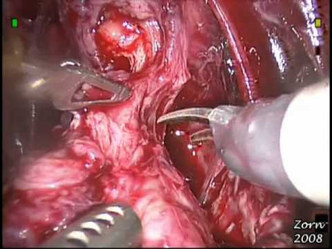 Robotic Radical Prostatectomy - STEP 8-  Urethral Division