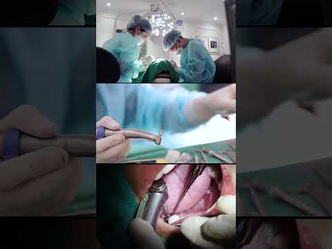 Cấy Ghép Implant Jet Dentist