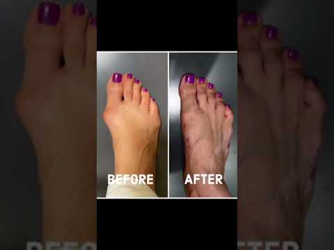 Get Ready to Be SHOCKED by This Bunion Transformation!