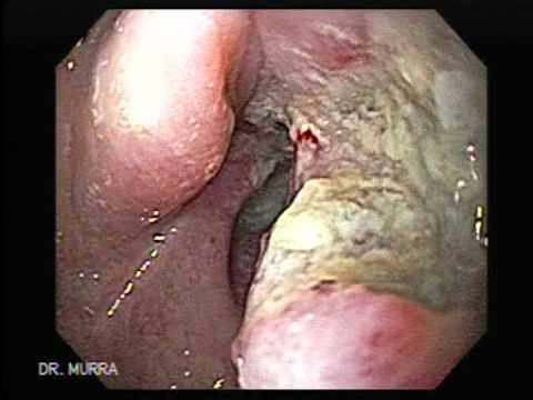 Papilloma on tongue treatment