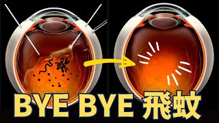 [問卦] 飛蚊症有救了