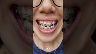 Download lagu Update: My 7 months braces journey (Class III Underbite) mp3