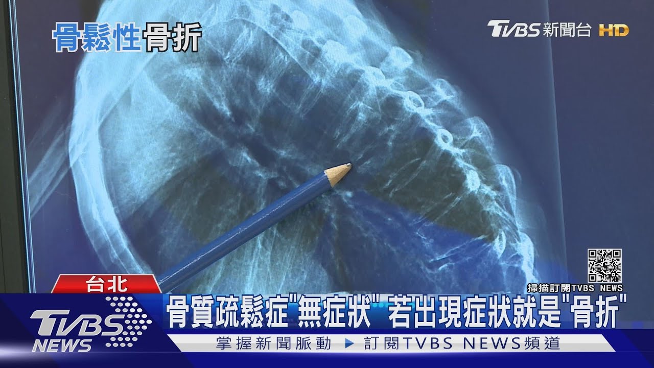 輕忽「骨質疏鬆症」 不注意「這件事」影響長期存活率!