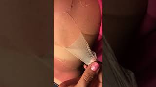 Massive sun burn skin peeling