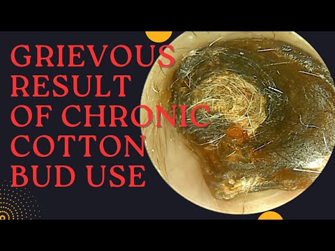GRIEVOUS Result Of Chronic Cotton Bud Use (Very Satisfying Earwax Removal)