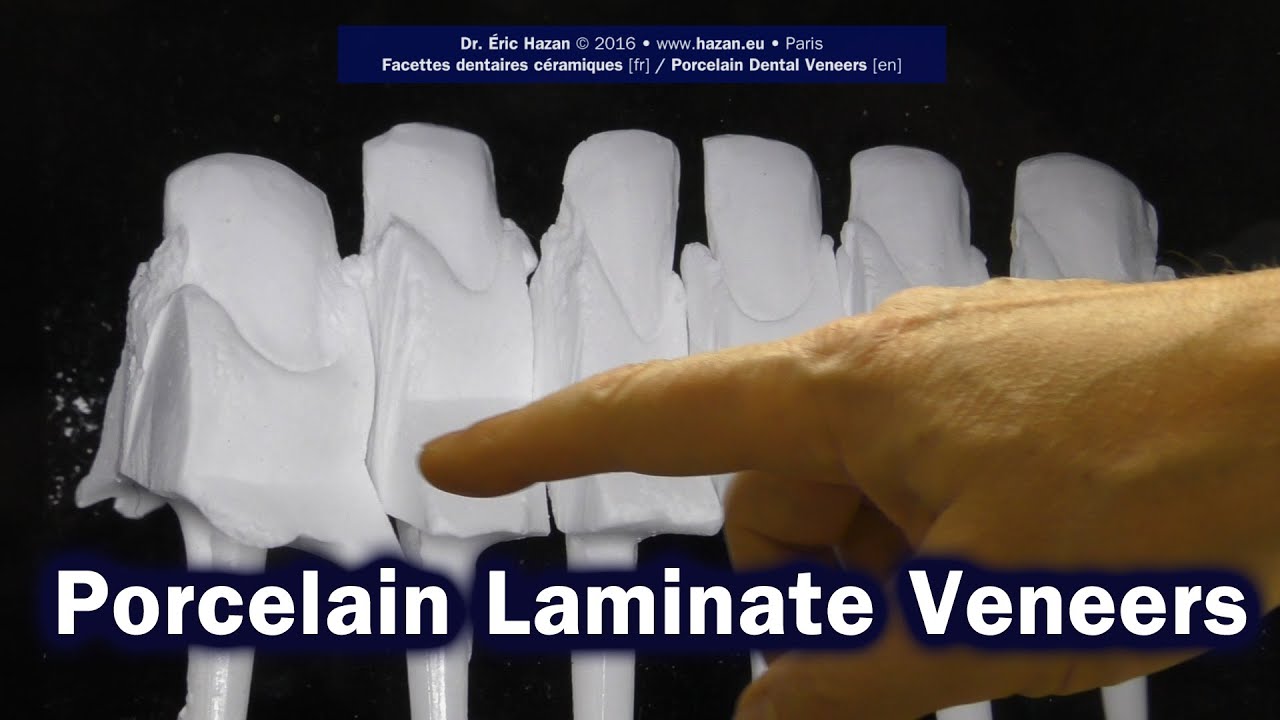 Porcelain Laminate Veneers No #15+ (steps) - Dr. Eric Hazan, Paris 16, France [en]