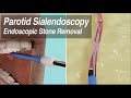 Parotid Sialendoscopy: Endoscopic Duct Stenosis Balloon Dilation & Salivary Stone Removal