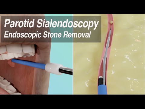 Parotid Sialendoscopy: Endoscopic Duct Stenosis Balloon Dilation & Salivary Stone Removal