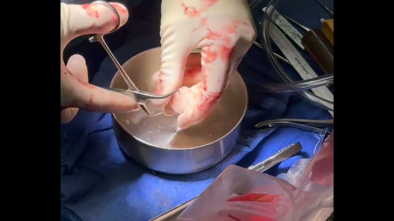 Distal Tibial Allograft with Humeral Head Allograft
