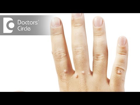 What are Warts & its treatment? - Dr. Rasya Dixit