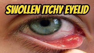Swollen Itchy Eyelids | Home Remedy for Swollen Eyelid | Red Itchy Puffy Eyes