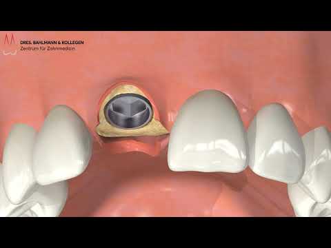 Implantate an einem Tag - Köln - Sofortimplantation