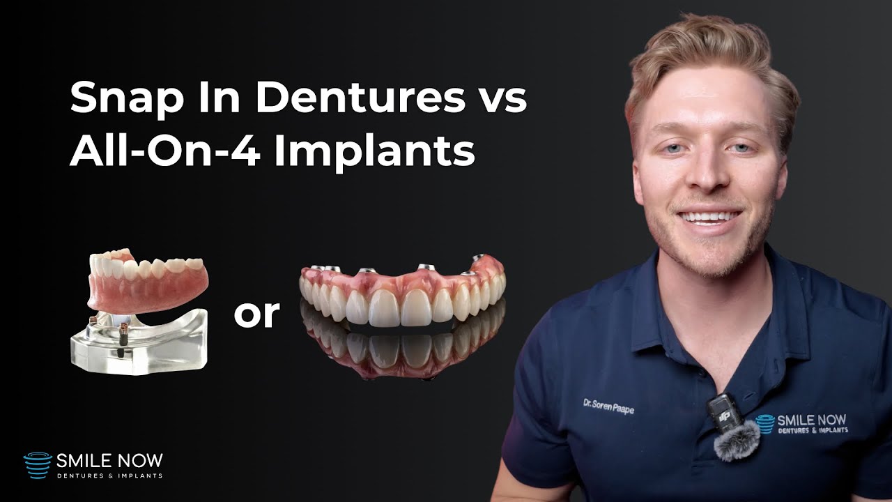 Snap In Dentures vs All On 4 Dental Implants