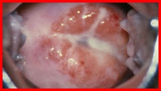 sintomas de la gonorrea tratamiento