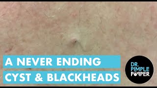 A Never Ending Cyst and Blackheads