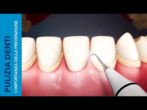 PULIZIA DEI DENTI | L'importanza della prevenzione - SkyDental 3D