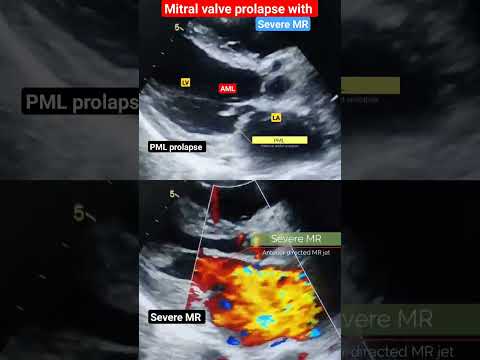 Mitral Valve Prolapse Echo l MVP l PML prolapse l Severe MR # echo # shorts