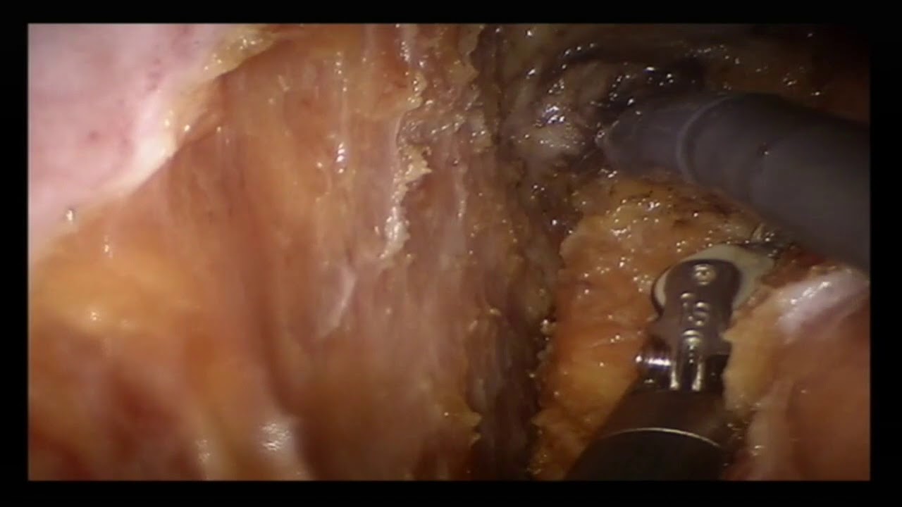 Simultaneous Robotic TME + Radical Prostatectomy & Iliac Lymphadenectomy for Synchronous Cancers