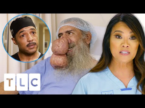 Dr. Lee & Specialists Finally Remove Roger's Enormous Rynophyma! | Dr. Pimple Popper