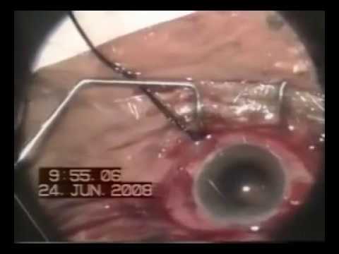 Vid-IC-APAO-pre-tied Hydrophobic foldable IOL Scleral Fixation-6