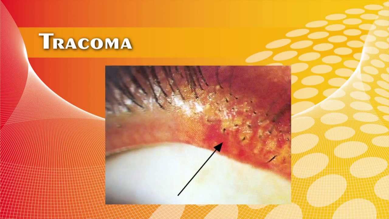Tracoma