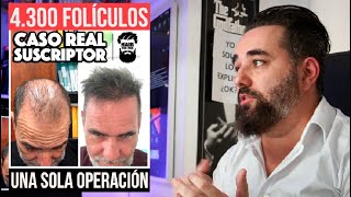 injerto capilar sin rapar realizado en Barcelona CASO REAL de un suscriptor