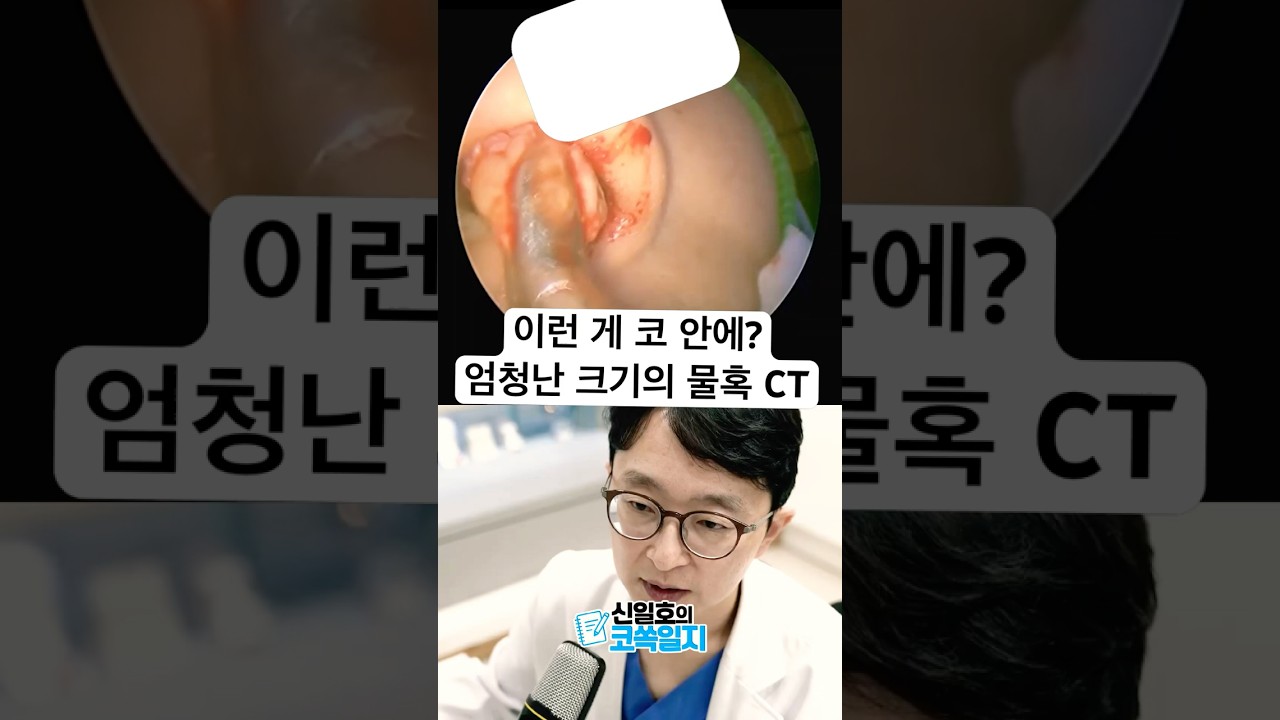 이런 게 코 안에? 엄청난 크기의 물혹 CT