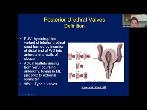 Posterior Urethral Valves - EMPIRE Urology Lecture Series