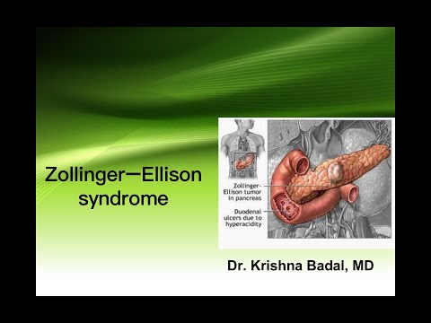 Zollinger Ellison syndrome