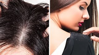Dandruff was Causing me a lot of Distress until I Found This Natural Remedy and Got Rid of it