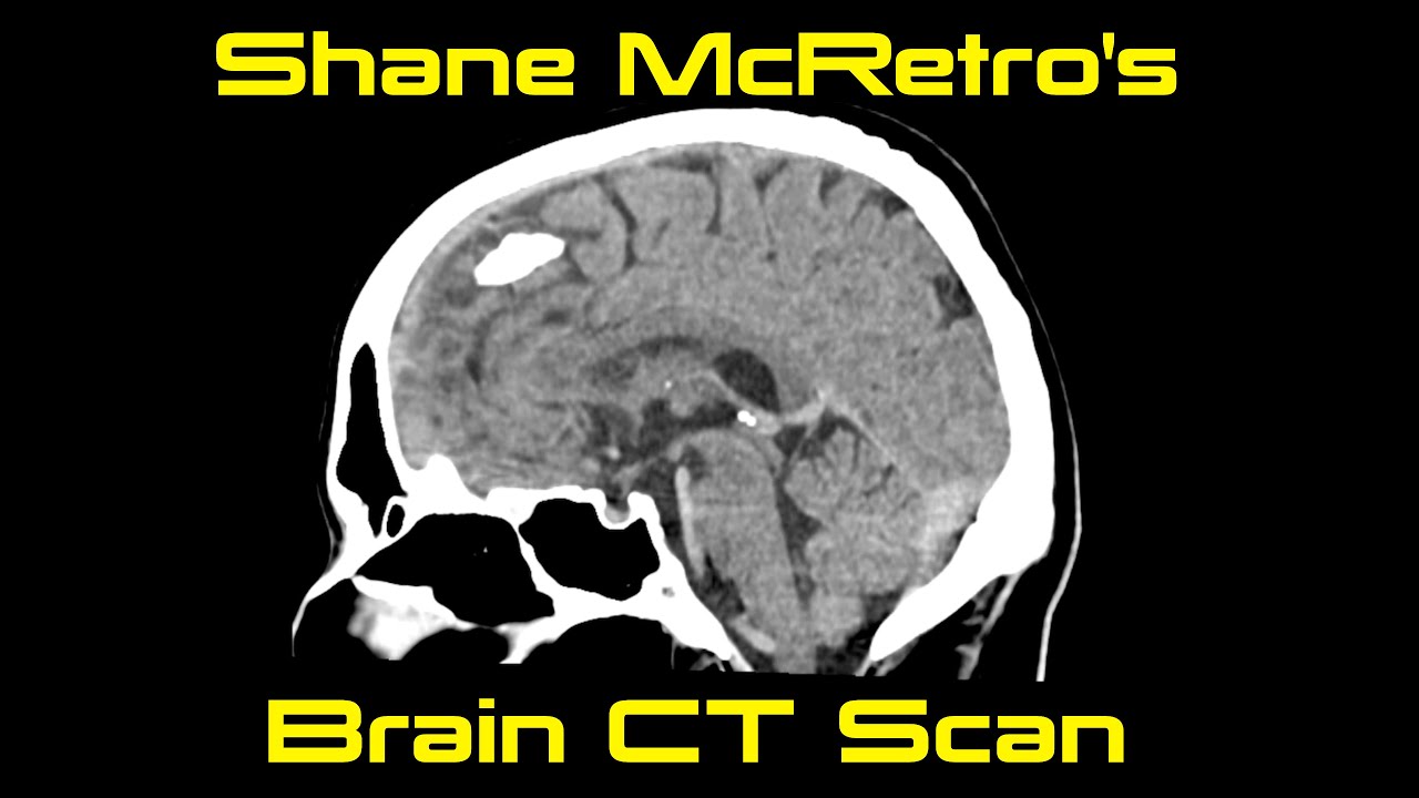 Shane's Brains! CT Scan - September 2023