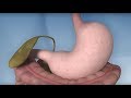 Gastric Bypass Complications Mayo Clinic