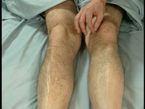 Stroke Scale Certification - Group A - Patient 1